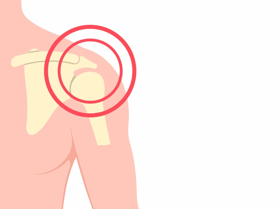 Illustrazione della riparazione della cuffia dei rotatori con ancorette e fili chirurgici.