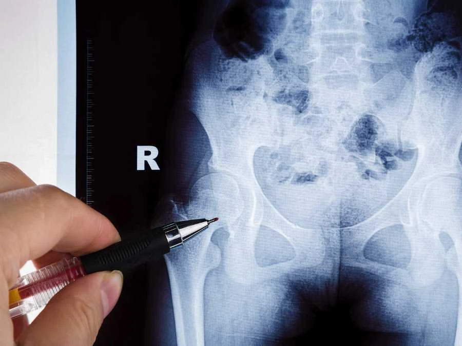 Medico valuta l’idoneità del paziente per la protesi d’anca con accesso anteriore