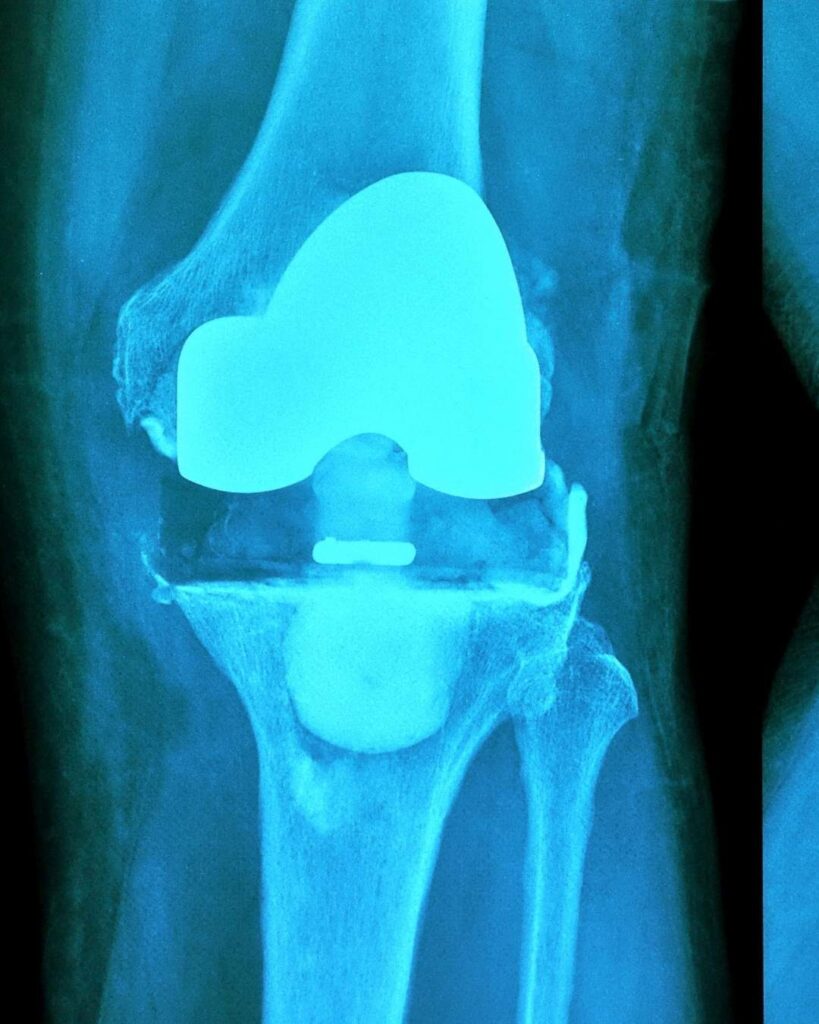 Radiografia di un ginocchio con protesi che mostra segni di usura o instabilità
