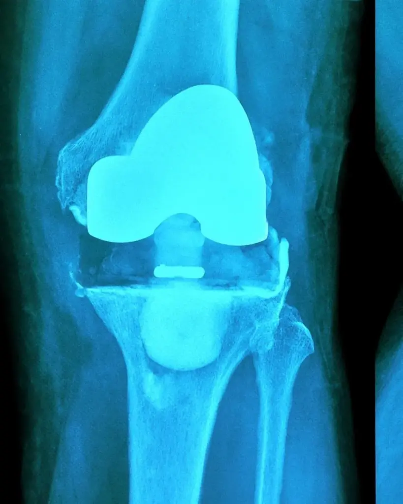 Radiografia di un ginocchio con protesi che mostra segni di usura o instabilità