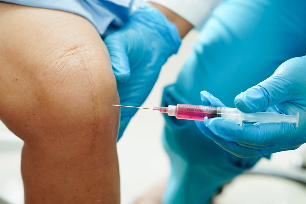 Infiltrazione di plasma ricco di piastrine al ginocchio eseguita sotto guida ecografica.