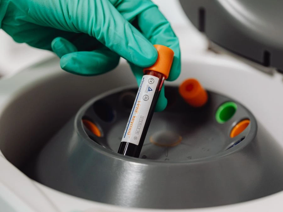 Preparazione del plasma ricco di piastrine tramite centrifugazione del sangue.