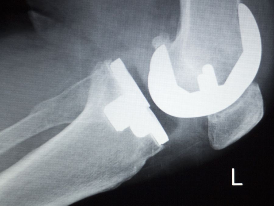 Radiografia di una protesi di ginocchio per valutare possibili cause di fallimento